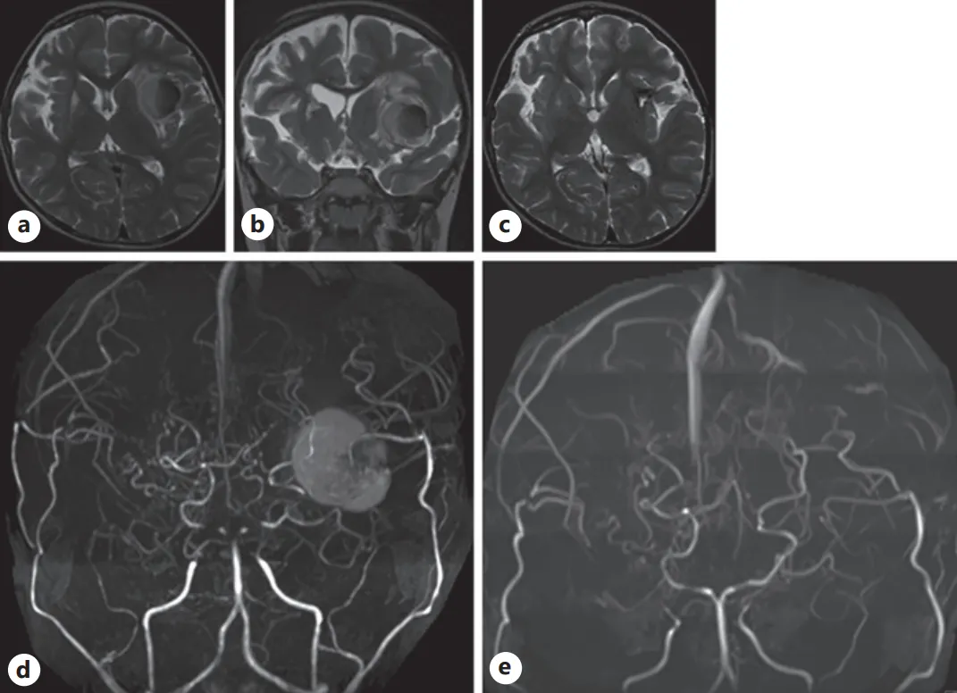 随访轴位（a）与冠状位（b）T2加权磁共振成像（MRI）图像