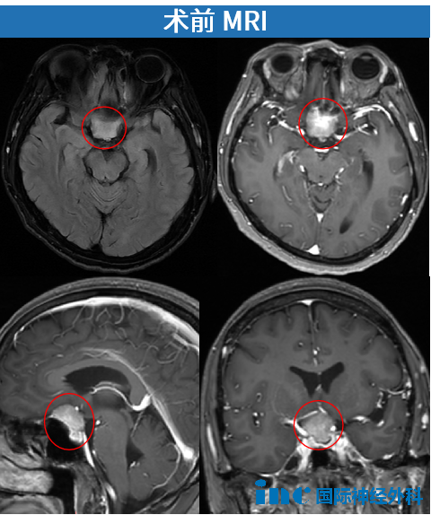 鞍区脑膜瘤影像