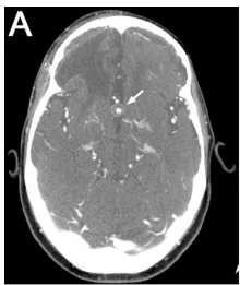 A:术前CT血管成像显示10.3毫米部分血栓形成的ACoA动脉瘤（箭头）。