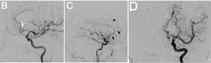 B:DSA侧位像显示动脉瘤（箭头）。C:DSA侧位像显示放射性血管炎，表现为血管分支减少及多处血管狭窄（箭头）。D:DSA正位像显示2年前Wada试验时未见动脉瘤或血管炎性改变。