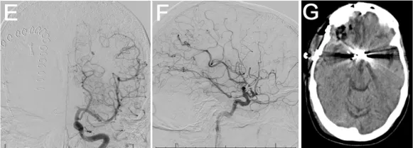 术后脑灌注成像显示一处术前已知的陈旧性脑梗死区域（图1H-J）。患者术后接受随访监测，时长23.9个月。