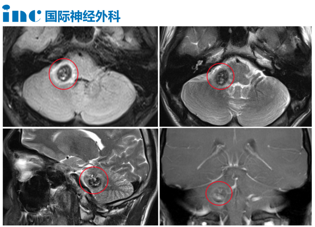 儿子因脑干出血病危,两次120转运,为何医生说法截然不同?