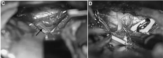 突发蛛网膜下腔出血却找不到病因？47岁患者的 “隐匿杀手”竟是夹层动脉瘤！