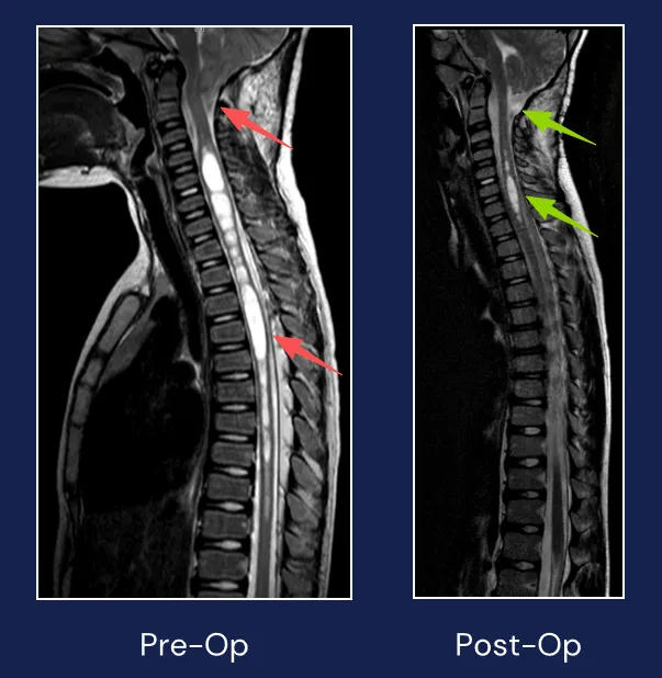 8岁女孩脊柱侧弯，医生却指着她的脊髓说：不好，这里有洞！