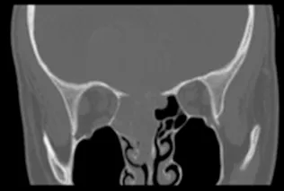 【INC国际大咖研究成果】儿童鼻腔鼻窦未分化癌：病例报告与文献综述