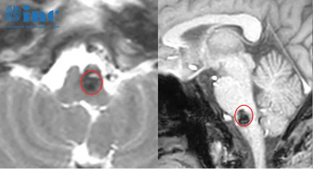 术后一天能说能动，来看INC巴教授如何拆除脑干 “高危病灶” ！
