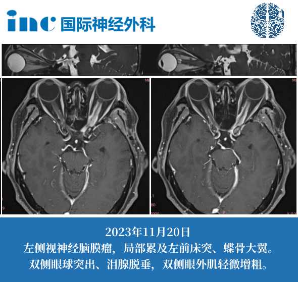 这个颅底脑膜瘤为什么不建议手术?背后原因是……