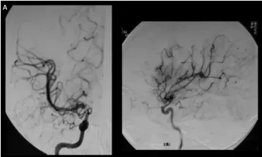 A，春奈术前右颈血管造影显示，在颈内动脉末端顶部，血管烟雾弥漫性发育，大脑中动脉扩张。