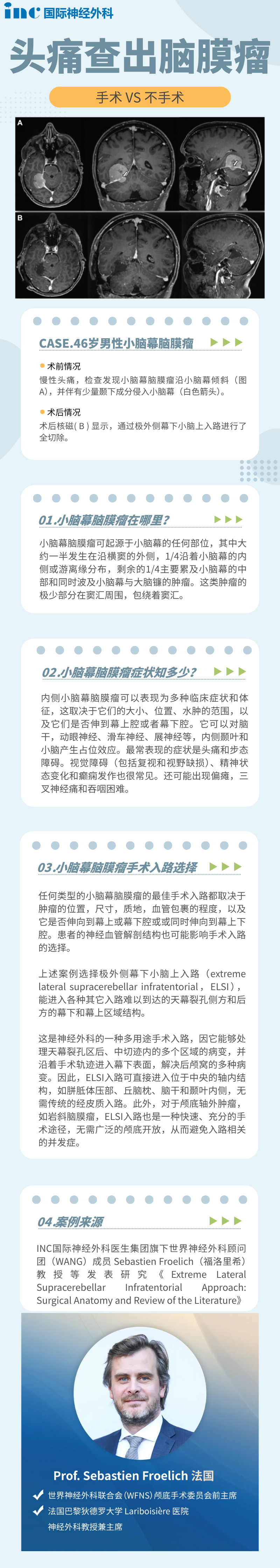 小脑幕脑膜瘤严重吗?当头痛查出,他会选择如何治疗?