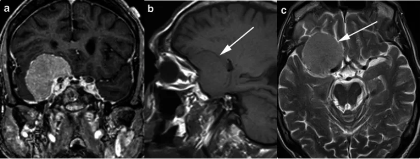 脑膜瘤MRI影像特征可以判断肿瘤良恶性吗?影像该怎么看?