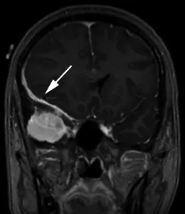 一名35岁头痛女性的造影后冠状T1加权序列显示