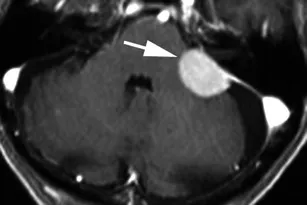 一名有头晕和易跌倒症状的83岁男性的造影后轴向T1加权序列显示