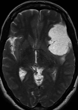 一名有8年晕厥发作史的55岁女性的轴向T2加权序列显示