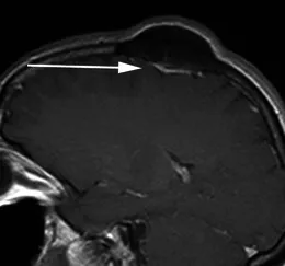 一名49岁女性患者，因头皮肿块就诊