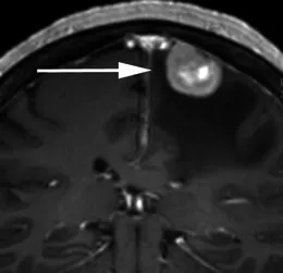 70岁头痛女性患者。增强冠状位T1加权序列显示右中央前回受压（箭头）
