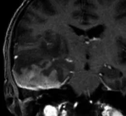 63岁滤泡性淋巴瘤病史男性患者