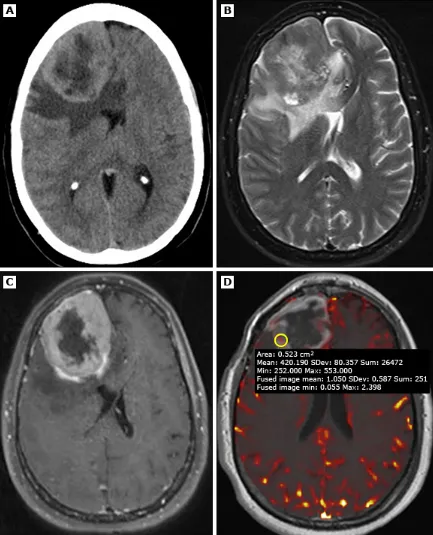 一名49岁患者，经病理证实为3级（间变性）脑膜瘤