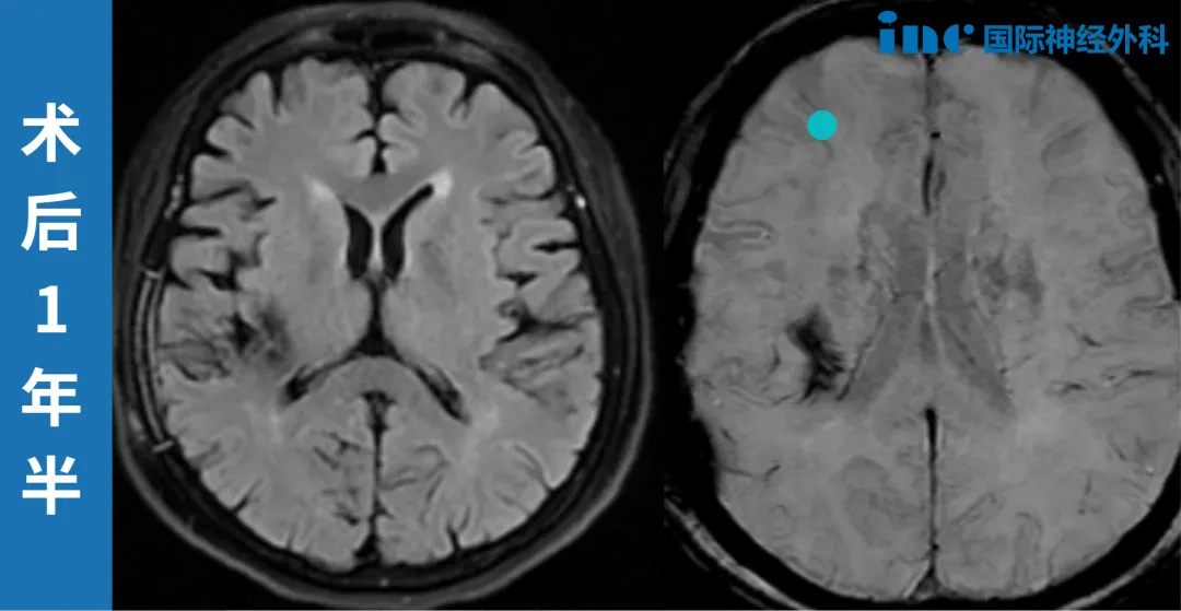 基底节区海绵状血管瘤