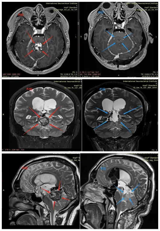 年年体检正常，视力下降却揪出脑瘤！这个松果体区肿瘤能治好吗？