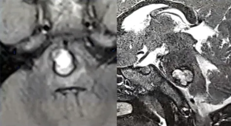 3岁男童突发脑干出血!头痛、半身瘫痪,情况危急