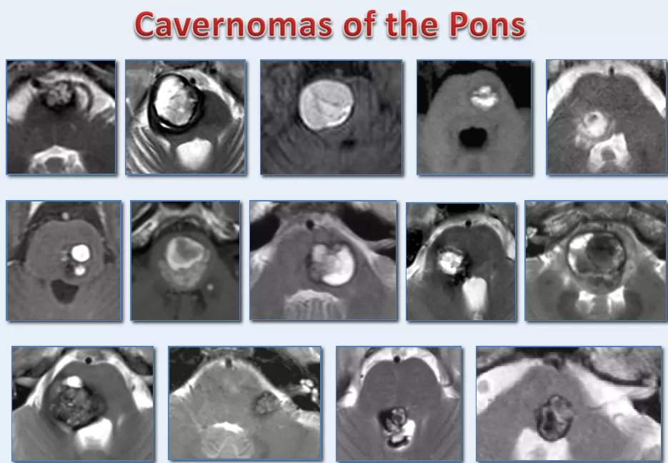 脑干脑桥海绵状血管瘤的影像学表现(INC巴特朗菲教授发表于医学期刊的手术病例)