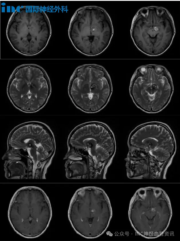 当眩晕呕吐不止，治疗却要赌上偏瘫风险？她该如何闯过丘脑海绵状血管瘤这一关？