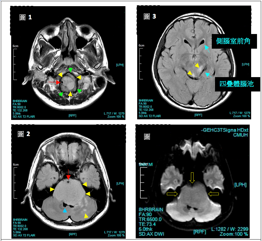 胶质瘤热点答疑 | 有关手术时机、切除率、并发症、复发……