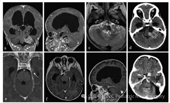 图6.患者10的左桥小脑角区脊索瘤影像学随访资料