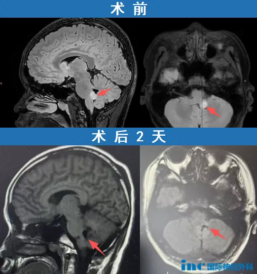 脑干胶质瘤影像
