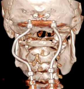 颅底手术  　　定制化  　　切除脑肿瘤