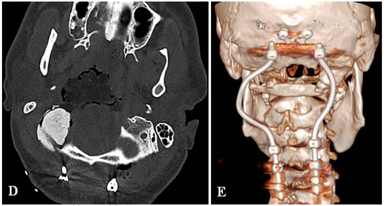 D:术后CT显示PMMA枕髁重建稳定良好。E:术后三维CT显示C0-C3-C4-C5枕颈融合稳定，与根钉弯曲有利于PBRT治疗。  　　图片