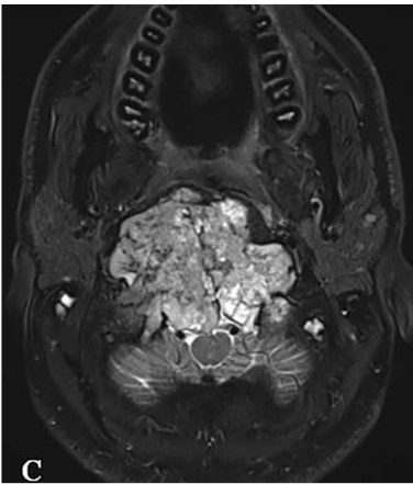 C:术前MR显示肿瘤巨大延伸，并浸润长入硬膜内的脑实质。