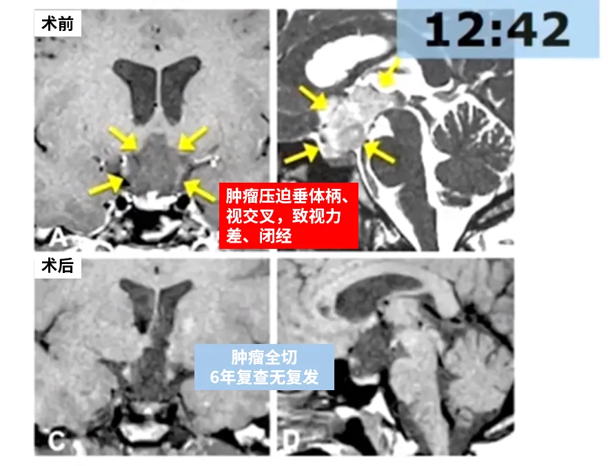 术后MRI证实全切（图C、D）