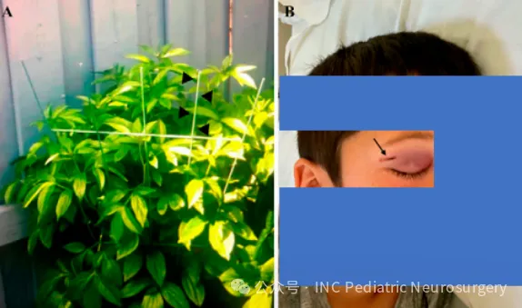 男孩遭铁杆刺入颅脑引发脑出血,未曾开颅,18个月后竟奇迹康复