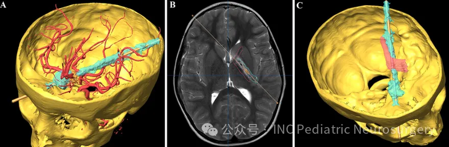 下图为患者头骨及损伤轨迹的三维（3D）重建