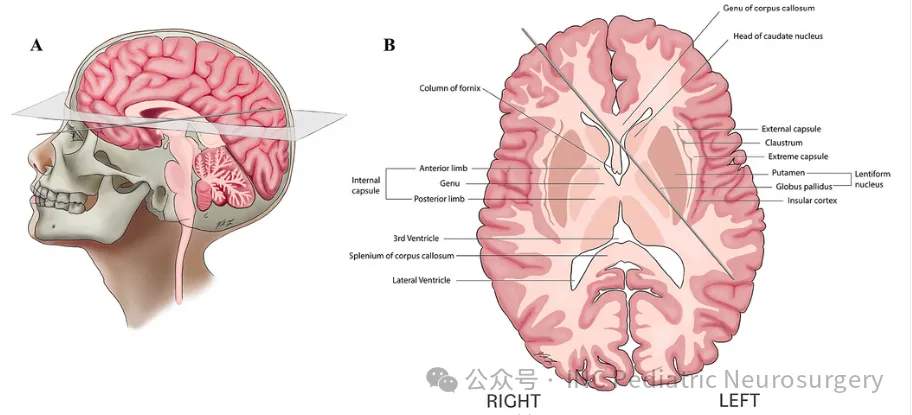 下图为尖端通过右侧眼眶进入颅骨的轨迹（A）及其与脑实质内功能结构的解剖关系（B）