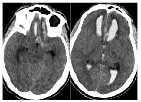失踪的8小时：男子外出彻夜未归，隐藏的脑血管＂杀手＂竟让他在寒夜倒地昏迷！
