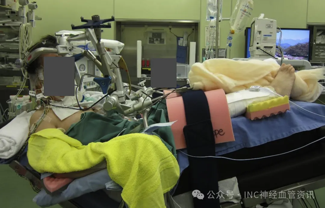 1瓶盖血就可能致命!脑干出血到底有多凶?能治吗?能手术吗?