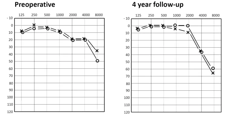 图4：术前（左图）与术后4年随访（右图）听力图对比。