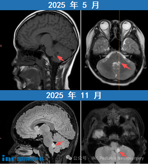 当医生说术后会嘴歪脸斜，脑干胶质瘤少年亲证：不仅不会，还能更好！