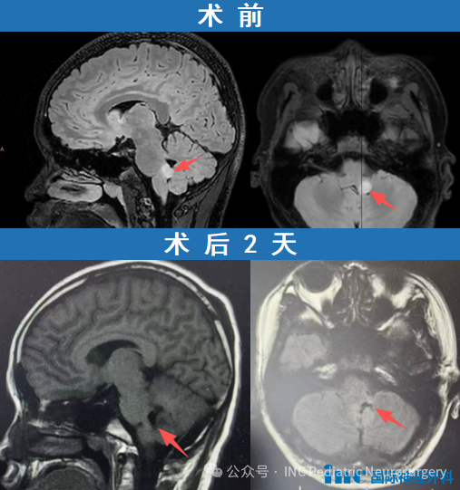 脑干胶质瘤影像