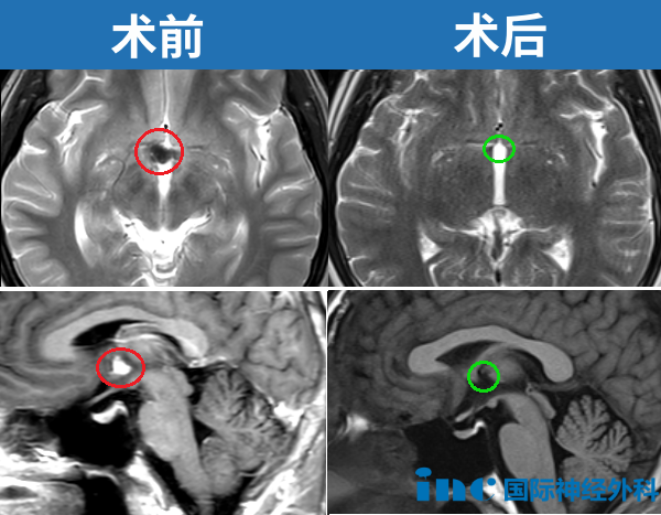 脑海绵状血管瘤影像