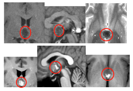 脑海绵状血管瘤影像