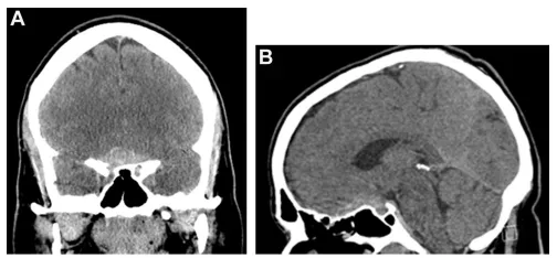 突发剧烈头痛、短暂失明:一个在脑子里“消失”又出现的离奇脑膜瘤