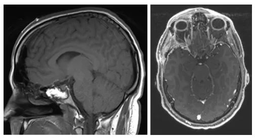 图3.（左）矢状位T1加权及（右）轴位T1加权增强MRI显示病变全切除，未见残留病灶。