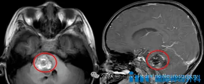 巨大的海绵状血管瘤