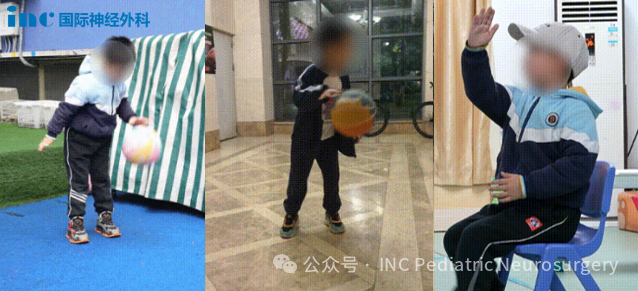 案例来源：2025年巴特朗菲教授于国内手术案例