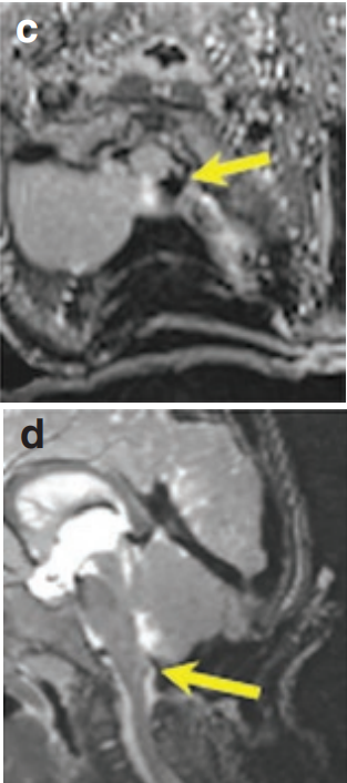 术中T1和T2MR（图c和d）