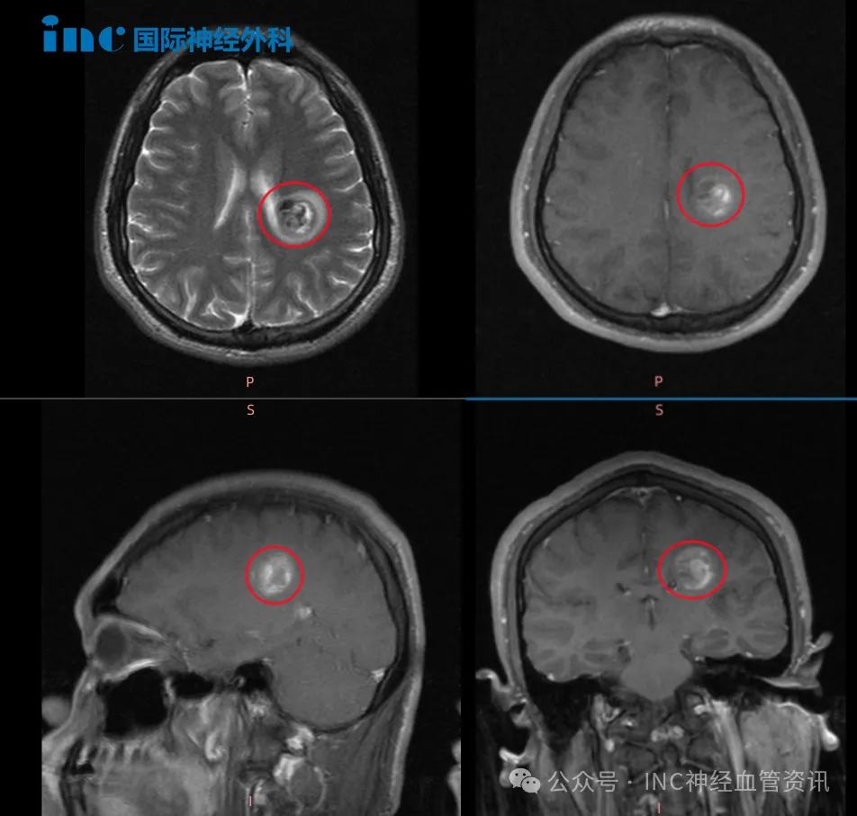 功能区海绵状血管瘤出血，导致肢体无力怎么办？