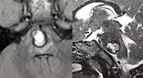 3岁幼童脑干出血险些病危,如今笑着烤出香软小面包!